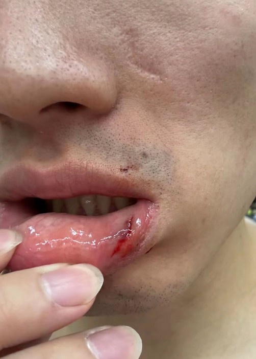 齐麟在社交媒体晒出于德豪嘴唇受伤的照片看起来有点严重