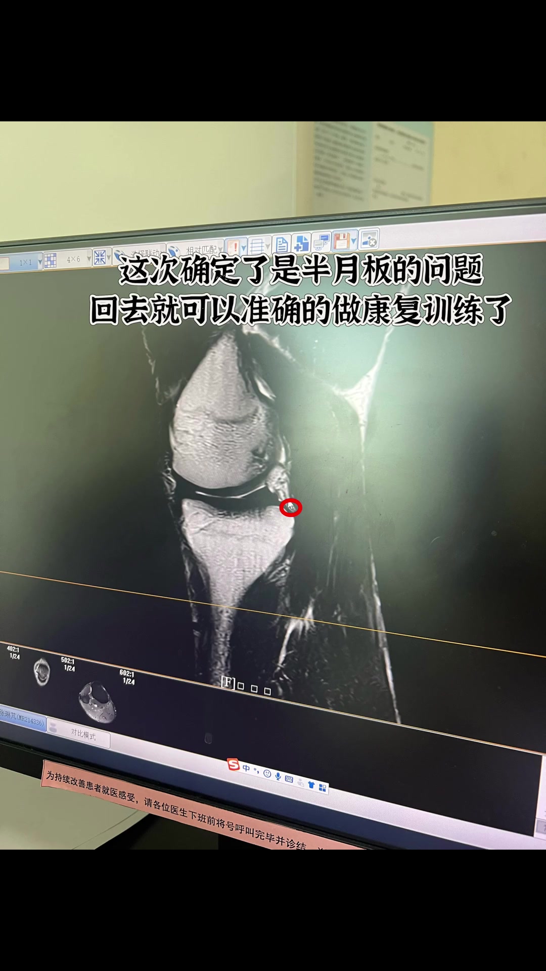 张琳芃妻子：张琳芃受伤位置此前始终没找对，现在确认是半月板